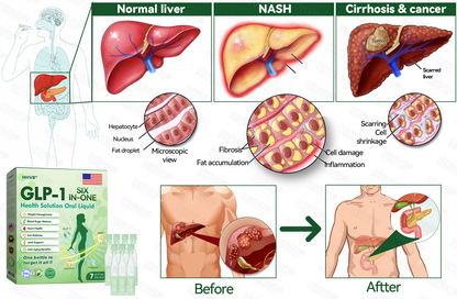 🇺🇸𝑶𝒇𝒇𝒊𝒄𝒊𝒂𝒍 𝑺𝒕𝒐𝒓𝒆  | 𝑯𝑯𝑽𝑩®🎁🎁𝐺𝐿𝑃-𝟏  𝑺𝑰𝑿 𝑰𝑵-𝑶𝑵𝑬 𝑯𝒆𝒂𝒍𝒕𝒉 𝑺𝒐𝒍𝒖𝒕𝒊𝒐𝒏 𝑶𝒓𝒂𝒍 𝑳𝒊𝒒𝒖𝒊𝒅  (𝐉𝐮𝐬𝐭 𝐨𝐧𝐜𝐞 𝐚 𝐝𝐚𝐲, 𝐯𝐢𝐬𝐢𝐛𝐥𝐞 𝐜𝐡𝐚𝐧𝐠𝐞𝐬 𝐢𝐧 𝟕 𝐝𝐚𝐲𝐬） ✅ 𝐅𝐨𝐫 𝐨𝐛𝐞𝐬𝐢𝐭𝐲, 𝐜𝐚𝐫𝐝𝐢𝐨𝐯𝐚𝐬𝐜𝐮𝐥𝐚𝐫 𝐡𝐞𝐚𝐥𝐭𝐡, 𝐝𝐢𝐚𝐛𝐞𝐭𝐞𝐬, 𝐬𝐥𝐞𝐞𝐩 𝐚𝐩𝐧𝐞𝐚, 𝐣𝐨𝐢𝐧𝐭 𝐢𝐬𝐬𝐮𝐞𝐬, 𝐚𝐧𝐝 𝐦𝐨𝐫𝐞